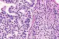 Adenosquamous carcinoma, with glandular features at left and squamous features at right.