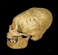 Proto Nazca elongated skull, c. 200–100&nbsp;BCE