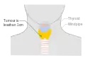 Stage T1a thyroid cancer