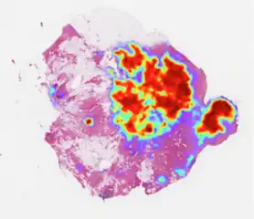Breast cancer prediction by AI.