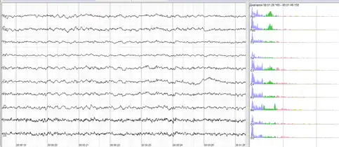 Human EEG with in resting state. Left: EEG traces (horizontal – time in seconds; vertical – amplitudes, scale 100&nbsp;μV). Right: power spectra of shown signals (vertical lines – 10 and 20&nbsp;Hz, scale is linear). 80–90% of people have prominent sinusoidal-like waves with frequencies in 8–12&nbsp;Hz range – alpha rhythm. Others (like this) lack this type of activity.