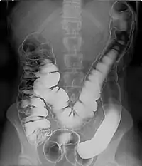 Double contrast barium enema - Using positive and negative contrast