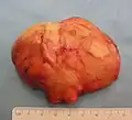 The resected lipoma(8&nbsp;cm × 6&nbsp;cm × 3&nbsp;cm)