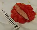 This lipoma was removed from the thigh of a 39-year-old male patient. It measured about 10&nbsp;cm in diameter at the time of removal. In the center is a section of skin that was removed with the lipoma.