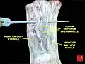 Abductor hallucis muscle