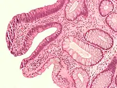Micrograph of a tubular adenoma&nbsp;– dysplastic epithelium (dark purple) on left of image; normal epithelium (blue) on right. H&E stain.