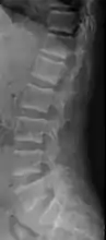 X-ray of a subtle "rugger jersey spine" due to sclerotic bands adjacent to the vertebral endplates.